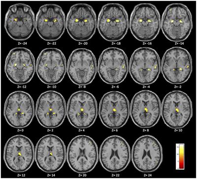 Association Between Hippocampus, Thalamus, and Caudate in Mild Cognitive Impairment APOEε4 Carriers: A Structural Covariance MRI Study